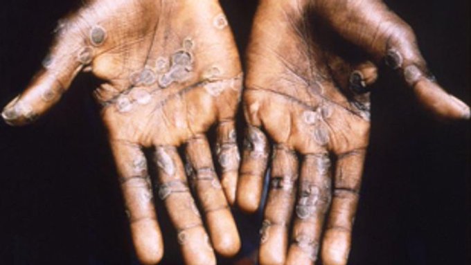 Deux cas de virus de la variole du singe découverts au Pays de Galles