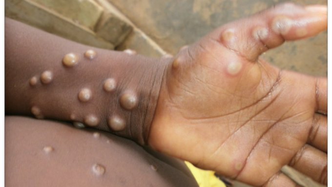 Le Royaume-Uni signale deux cas de monkeypox et lance la recherche des contacts